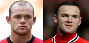 Wayne Rooney's hair transplantation